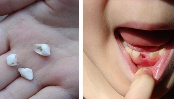 Lekári odkazujú rodičom. Za žiadnych okolností nevyhadzujte mliečne zuby vaši detí. Neskôr Vám poďakujú