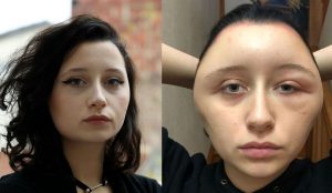 Žene dvojnásobne napuchla tvár, len kvôli tomu, že použila farbu na vlasy „Urobila som chybu a teraz chcem všetkých varovať.“