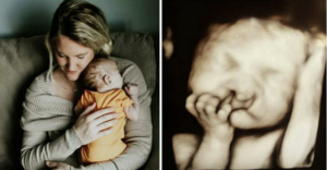 Odmietli potrat aj napriek deformácii tváre ich ešte nenarodeného dieťatka. Takto vyzerá o 2 roky neskôr