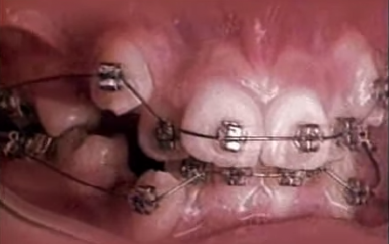 Čo sa stane so zubami, keď na ne 18-mesiacov pôsobí strojček?