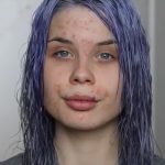 tZo1.slovenka_radka_kovacova_chcela_pomoct_dievcatam_ktore_maju_akne_