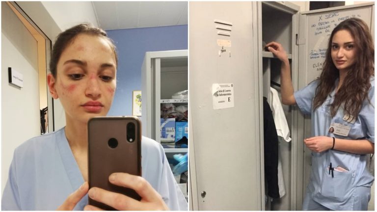 Únava a modriny: Talianska sestrička zdieľala fotky z nemocnice