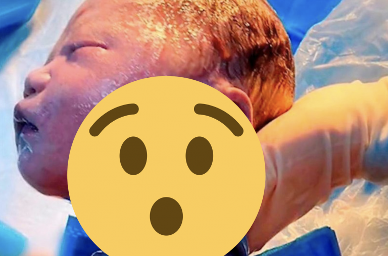 Zázrak medicíny: Dieťatko malo okolo krku omotanú pupočnú šnúru 6-krát! Prežilo