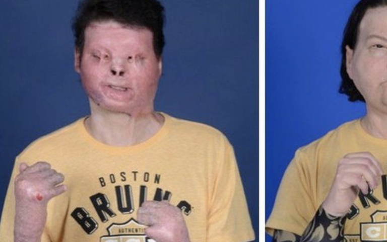 V Amerike prebehla prvá úspešná transplantácia tváre a rúk. Operácia trvala neuveriteľných 23 hodín!