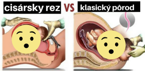 Fakty o prirodzenom pôrode a cisárskom reze, ktoré musí vedieť každá žena bez rozdielu veku