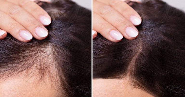 Tip: Ako prebudiť spiace vlasové folikuly. Vypestujte si zdravé a krásne vlasy