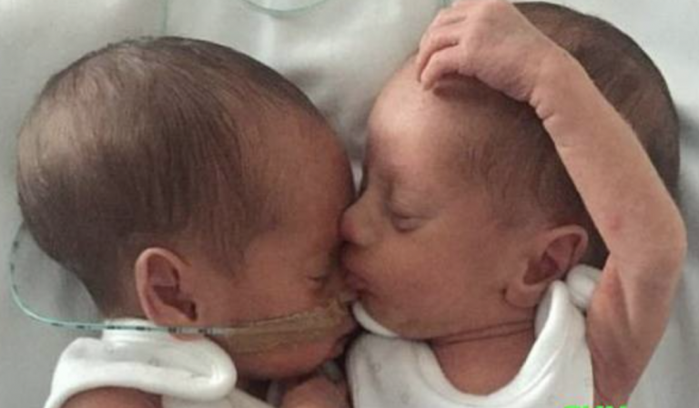 Dvojičkám hrozila smrť. Lekári im dávali 10-percentnú šancu na život