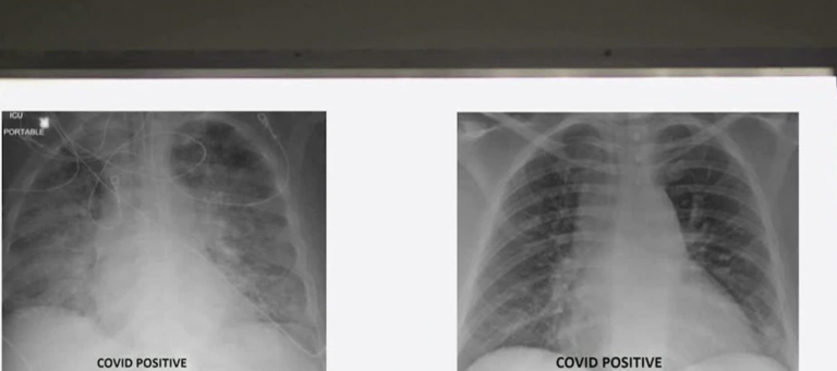 Takto vyzerajú röntgenové snímky pľúc po napadnutí koronavírusom. Zaočkovaní ľudia majú veľkú výhodu