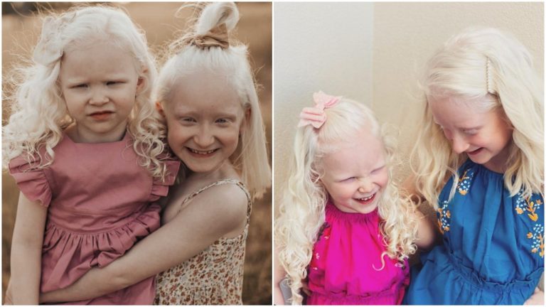 Mám 2 deti, ktoré trpia albinizmom a sú nevidiace. Aj napriek tomu ich milujem – Skutočný príbeh