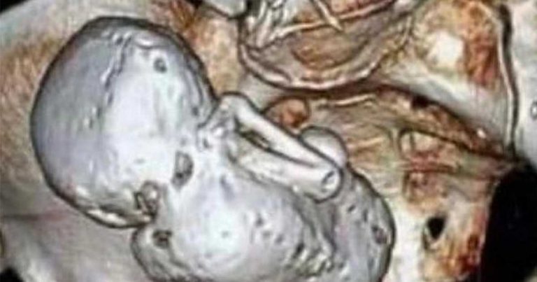 73-ročná žena nosila v bruchu „kamenné dieťa“. Lekári neverili vlastným očiam