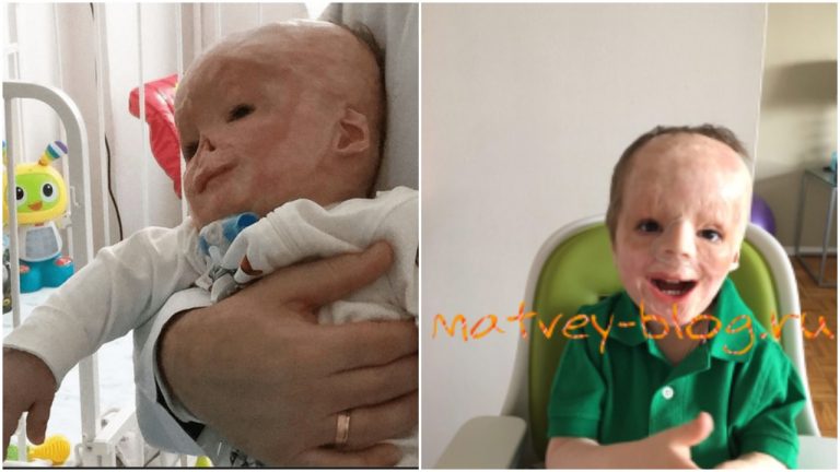 Chlapec prežil nehodu a 75% jeho tela pokrývali popáleniny. Jeho mamička ho ale opustila pre…