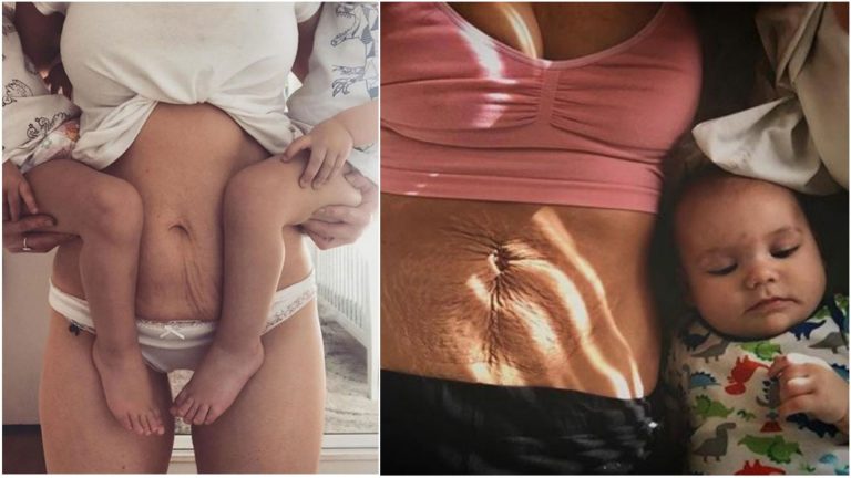 20 úprimných fotografií o tom, ako vyzerá ženské telo krátko po pôrode