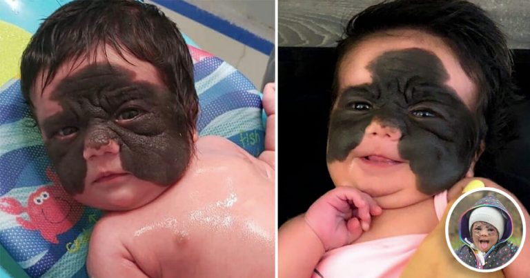 Dievčatku po prelomovej operácii odstránili materské znamienko z tváre. TAKTO VYZERÁ DNES