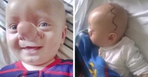Smiali sa jej dieťatku a prezývali ho Pinokiom. Po operáciách je jeho úsmev nádherný.