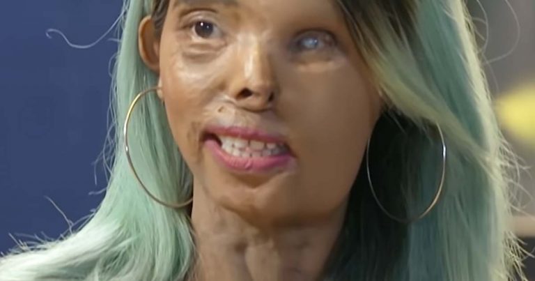 Otec ju polial kyselinou, keď bola malá. Pozrite sa, ako vyzerá dnes. Je z nej krásna modelka