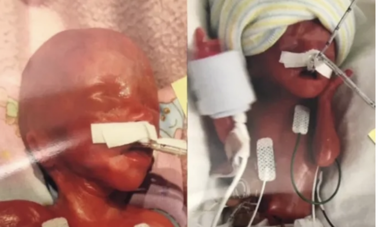 Ako dnes vyzerajú svetovo najviac predčasne narodené dvojčatá?