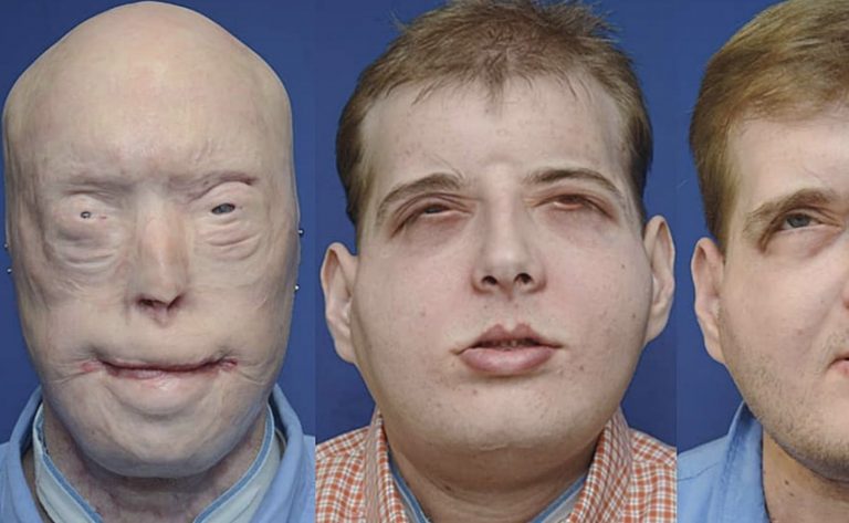 Hasičovi transplantovali tvár po popáleninách tretieho stupňa. TAKTO VYZERÁ DNES