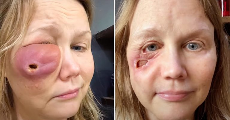 Žena zostala po nešťastnom zákroku s veľkou dierou v tvári. TAKTO VYZERÁ DNES