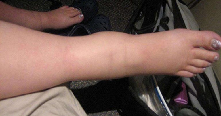 Trápia vás v týchto teplých dňoch opuchnuté nohy? Toto vám uľaví