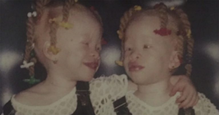 Dvojičky albínky inšpirovali celý svet. Dnes majú 24 a takto žijú. AKO SA ZMENILI?