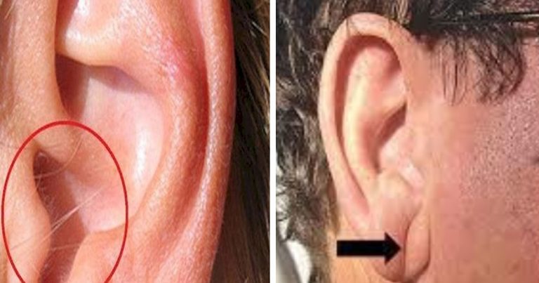 Máte chĺpky v uchu a takýto ohyb? Toto sú signály, ktoré by ste nemali ignorovať