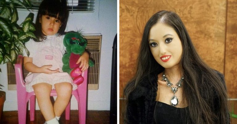 Porcelánová bábika: vzácna choroba spôsobila, že pokožka mladého dievčaťa vyzerá ako neživá