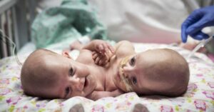 Takú operáciu ste ešte nevideli. Lekári oddeľovali siamské dvojčatá