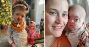 Dievčatku, ktoré sa narodilo so zriedkavou chorobou, lekári počas operácie za 4 milióny eur upravili lebku