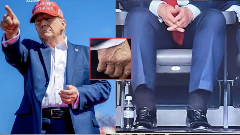 Tajomstvo za modrinami: Trumpovi diagnostikovali TENTO DRUH CHOROBY